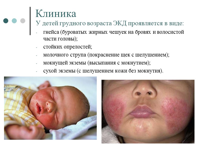 Клиника У детей грудного возраста ЭКД проявляется в виде:  гнейса (буроватых жирных чешуек